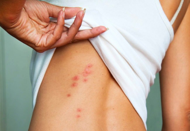 bed bugs bites